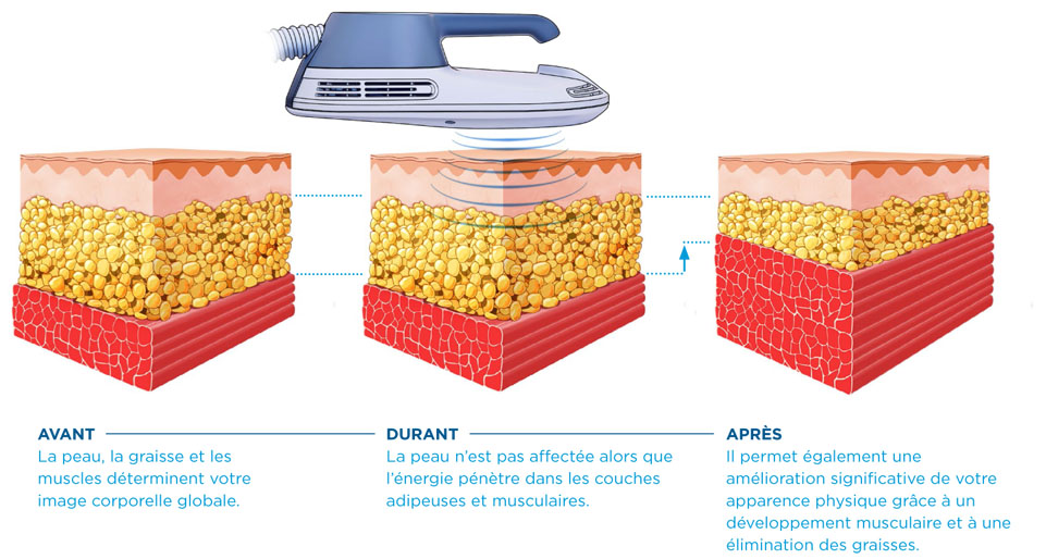 emsculpt_fonctionnement