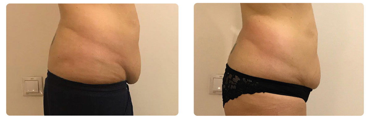 Photo avant / après de traitement des amas graisseux du ventre par Onda Coolwaves