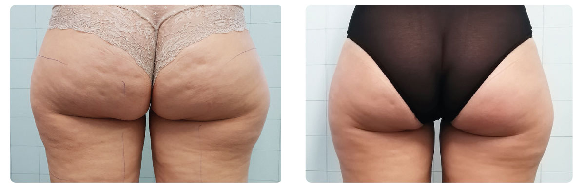 Photo avant / après de traitement de la cellulite des fesses par Onda Coolwaves